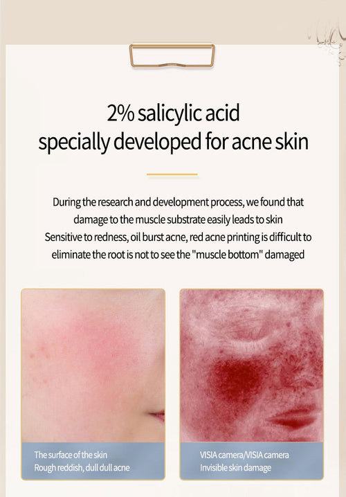 Acne Removing Salicylate Facial Essence – Blemish Control & Pore Clarifying Serum