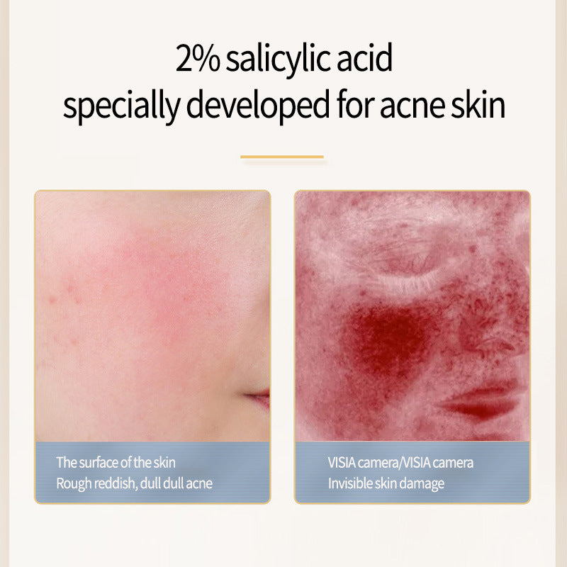 Acne Removing Salicylate Facial Essence